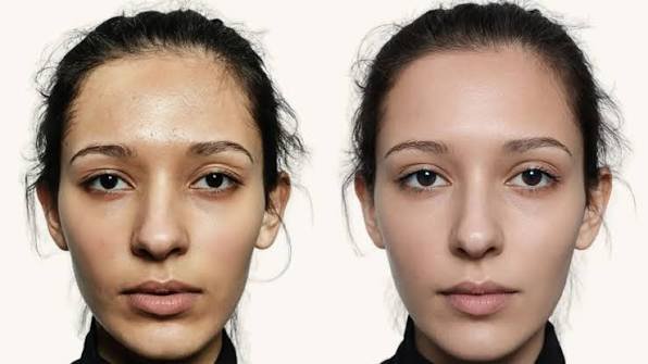 microneedling before and after