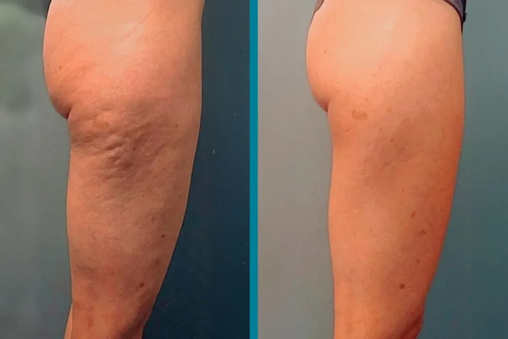 Cellulite Treatment Before & After