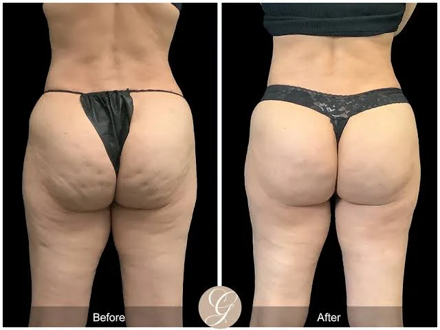 Cellulite Treatment Before & After