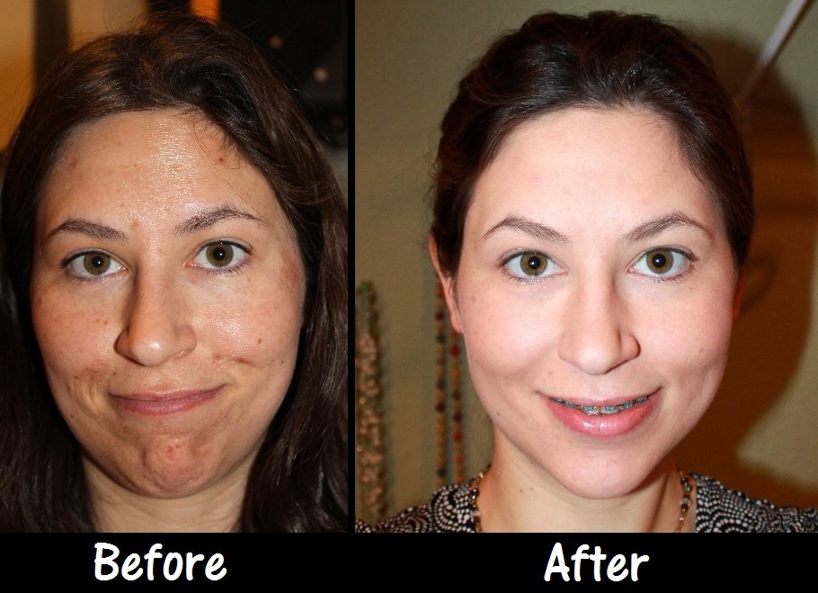 before and after Chemical Peeling