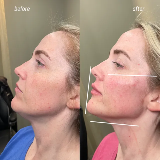 Full Face Balancing before and after