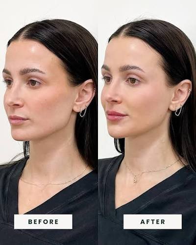 Full Face Balancing before and after