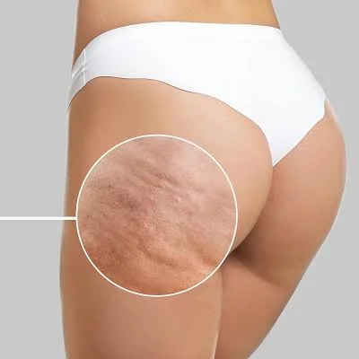 What Is Cellulite