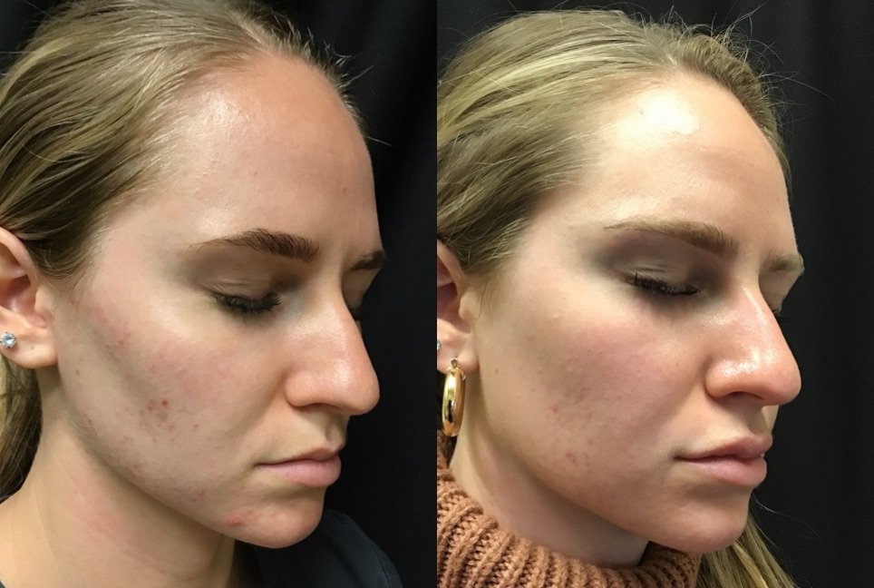 before and after Chemical Peeling