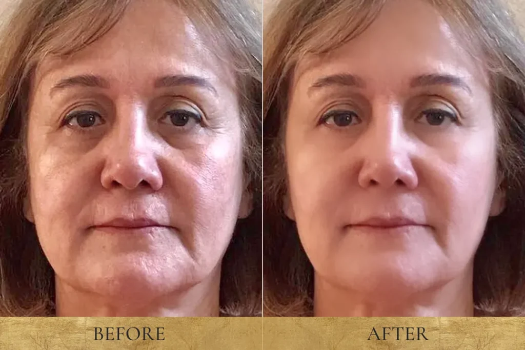 Lines & Wrinkles Consultation befor and after