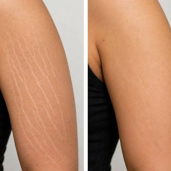 Stretch Mark Treatment before and after