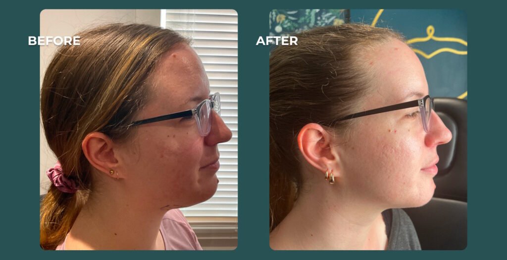fat dissolving injections before and after