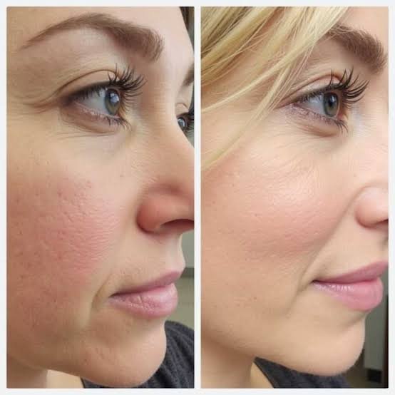 prp skin rejuvenation before and after